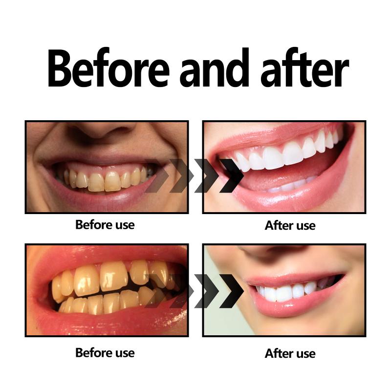 치아 미백 파우더 숯/베이킹 소다 치아 미백 파우더,  - Teeth Whitening Baking Soda 리뷰 및 가격