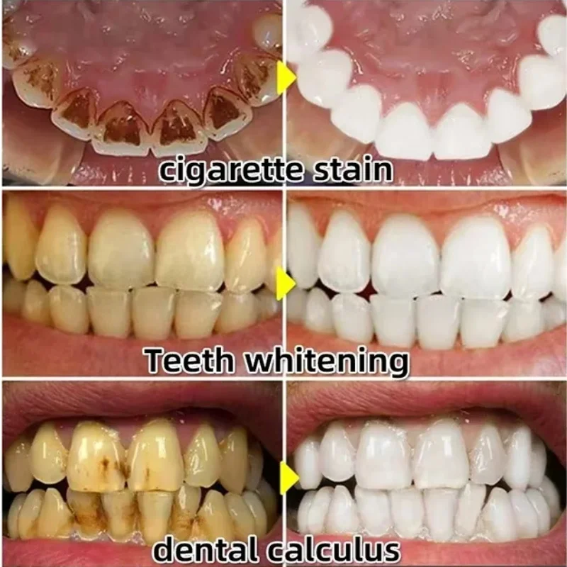 치약 세럼으로 빠르게 치아 주위 조직 회복, 치아 미백 - Teeth Whitening Baking Soda 리뷰 및 가격