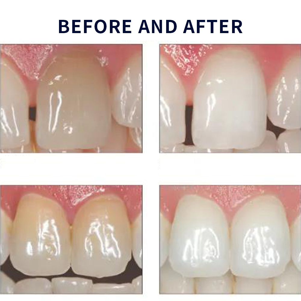 유백광 미백 20% PF 20 16 젤 키트, 초강력  - Teeth Whitening Hydrogen Peroxide 리뷰 및 가격
