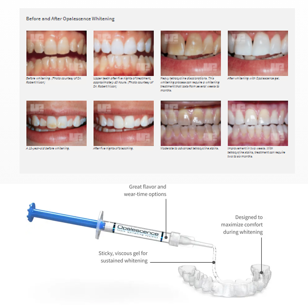 유백광 미백 20% PF 20 16 젤 키트, 초강력  - Teeth Whitening Hydrogen Peroxide 리뷰 및 가격