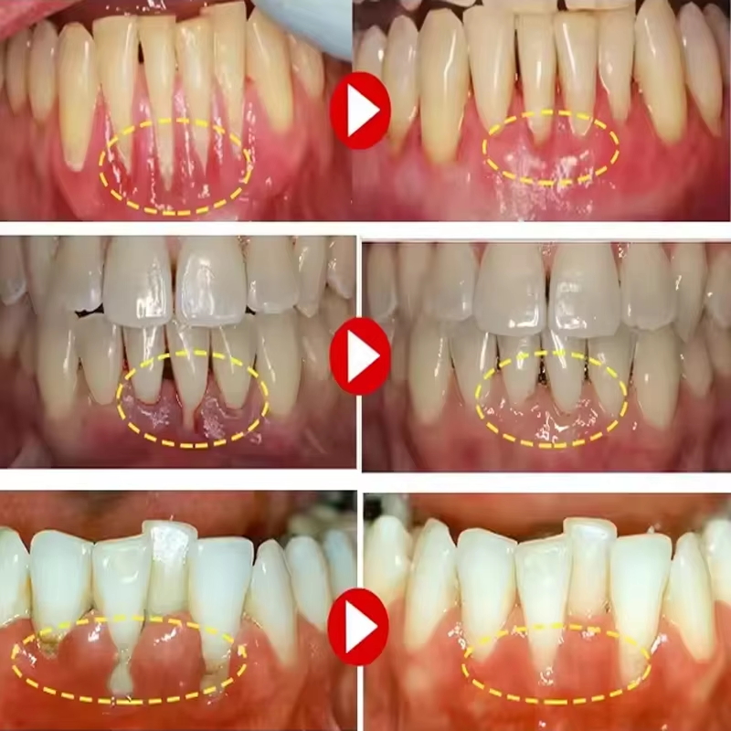 치아 미백 젤 잇몸 복구 케어 잇몸 손상 염증 개선 청 - Teeth Whitening Gels 리뷰 및 가격