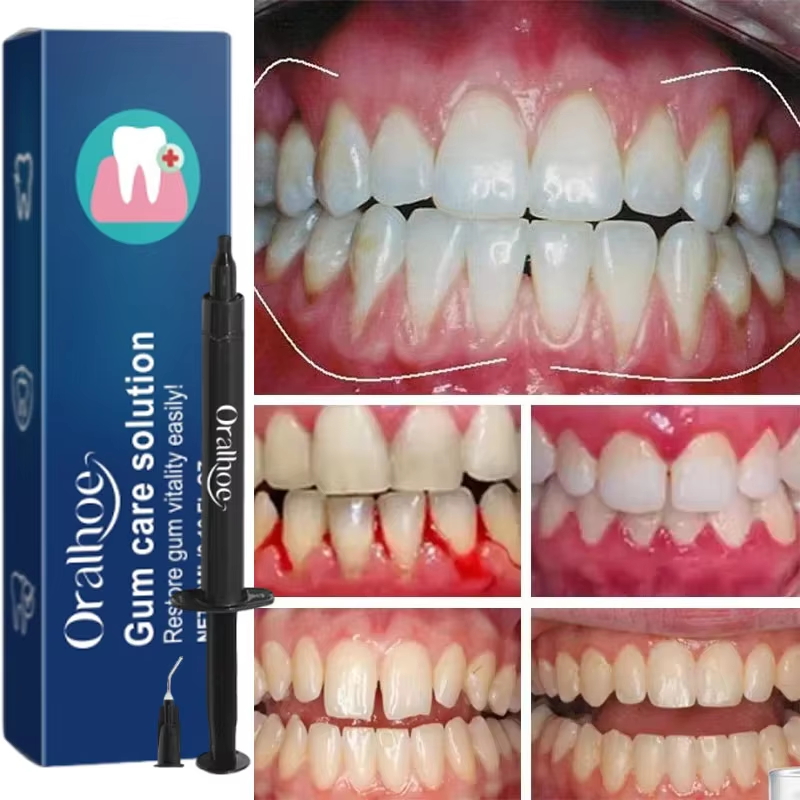 치아 미백 젤 잇몸 복구 케어 잇몸 손상 염증 개선 청 - Teeth Whitening Gels 리뷰 및 가격