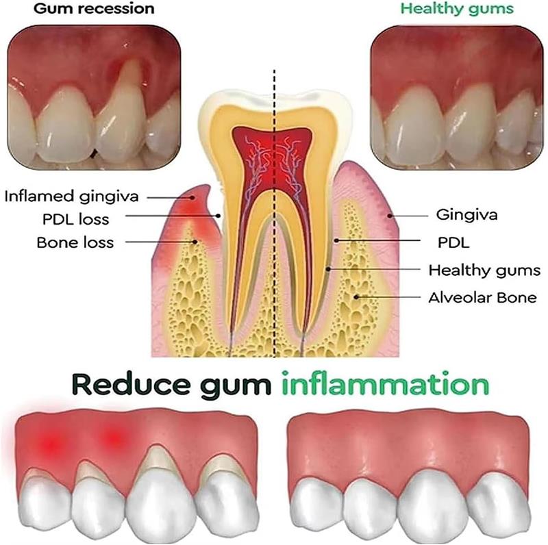 치아 미백 젤 잇몸 복구 케어 잇몸 손상 염증 개선 청 - Teeth Whitening Gels 리뷰 및 가격