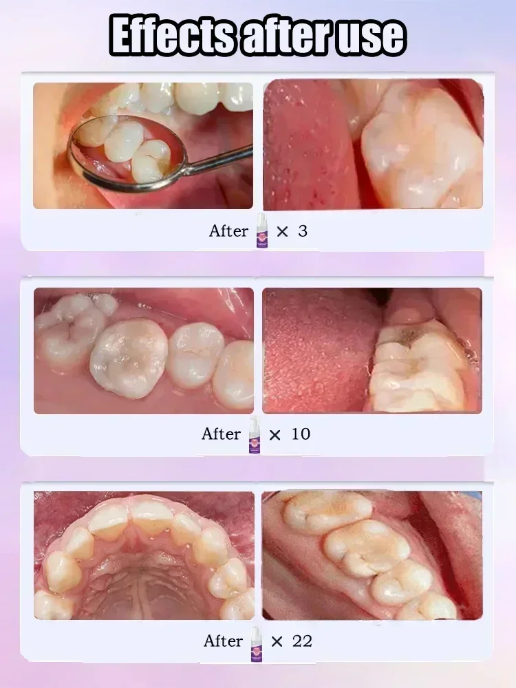 치아 부패 복구, 충치 치료, 충치 예방 - Teeth Whitening Charcoal Powder 리뷰 및 가격
