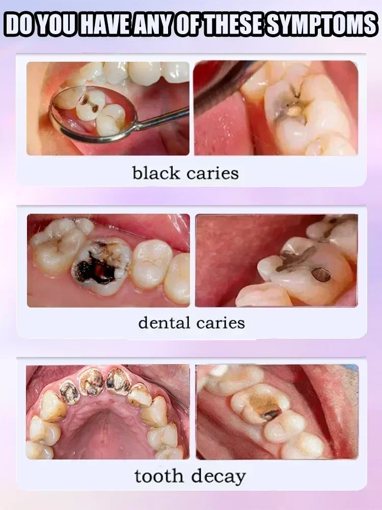 치아 부패 복구, 충치 치료, 충치 예방 - Teeth Whitening Charcoal Powder 리뷰 및 가격