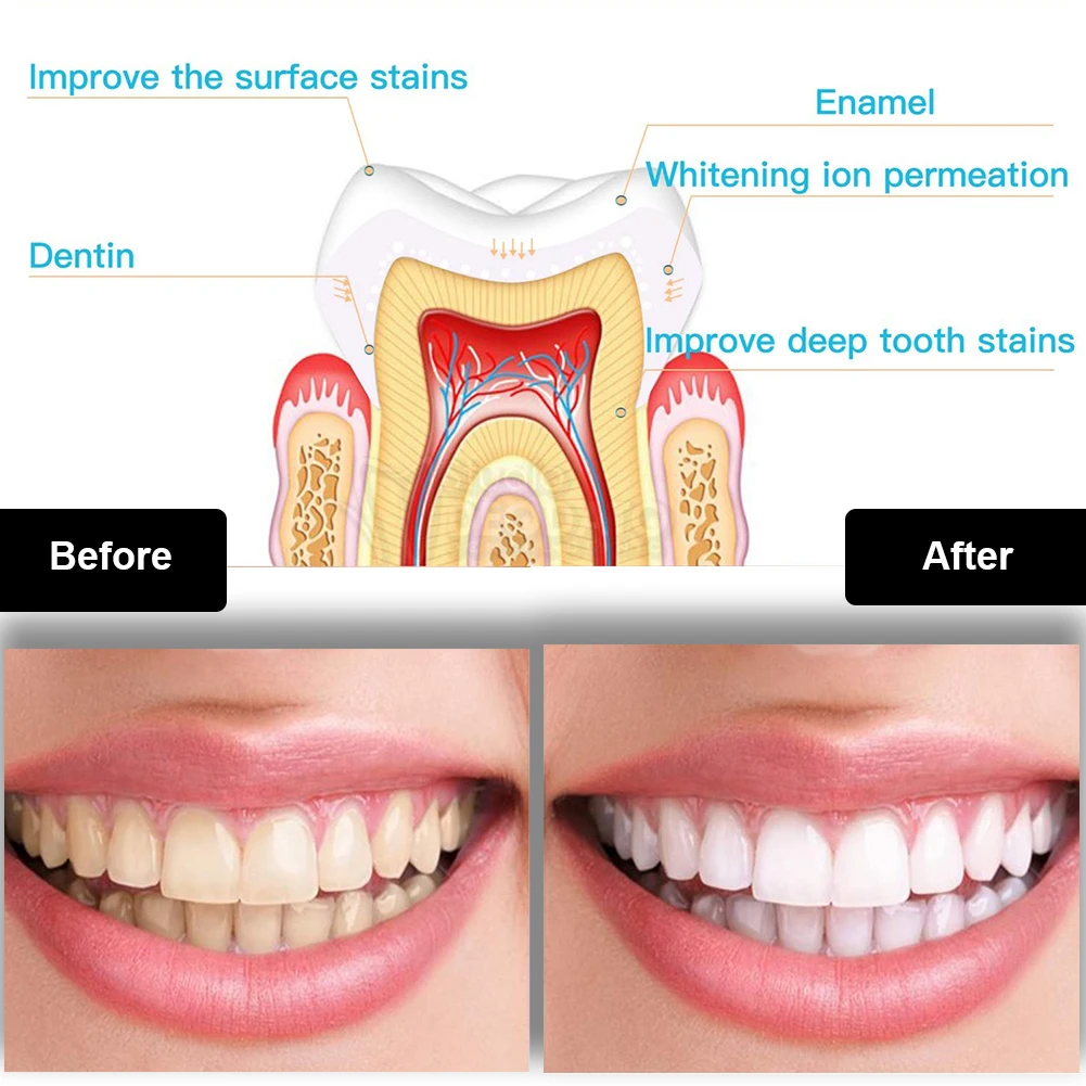 치과 치아 미백 키트 미니 16 LED 콜드 라이트 3 - Teeth Whitening Gel Pen 리뷰 및 가격