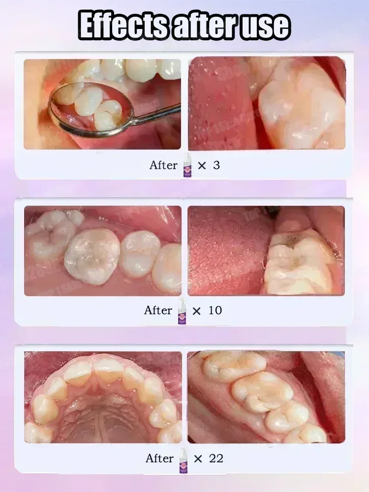 뜨거운 판매 베스트셀러, 과학적인 충치 수리, 충치 제 - Teeth Whitening Charcoal Powder 리뷰 및 가격