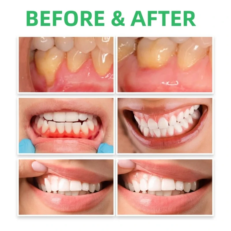 잇몸 수리 방울, 잇몸 붓기 완화, 잇몸 청소 관리,  - Teeth Whitening Paste 리뷰 및 가격